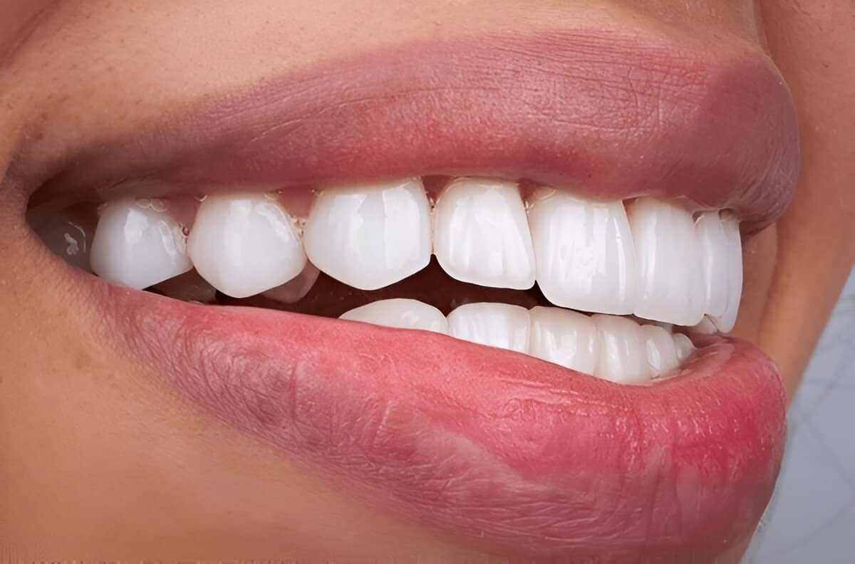dental bonding near you